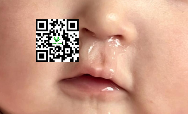 Cách Trị Sổ Mũi, Khò Khè Cho Bé Một Cách An Toàn Bằng thảo dược