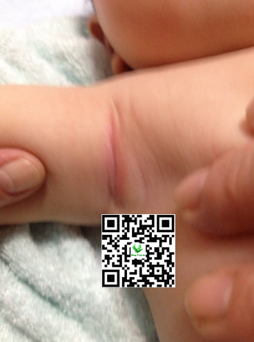 Cách chữa hăm nách cho trẻ sơ sinh