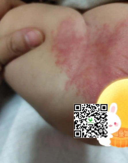 Cách trị hăm bẹn cho bé