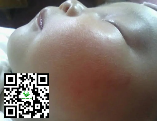 Chàm sữa ở Mức độ nhẹ