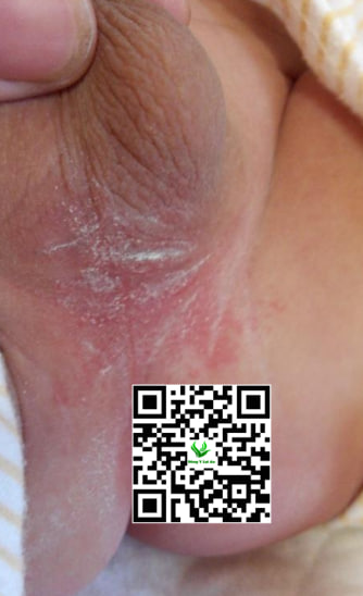 Da bìu của trẻ bị chà xát