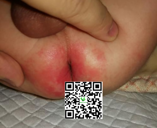Da mẩn Đỏ, Sưng Tấy, phát ban Quanh Hậu Môn là dấu hiệu bị hăm