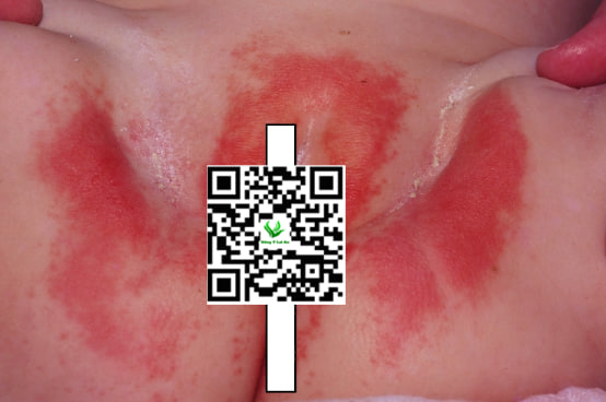 Dấu Hiệu Bé Gái Bị Hăm Bướm phát đỏ tã