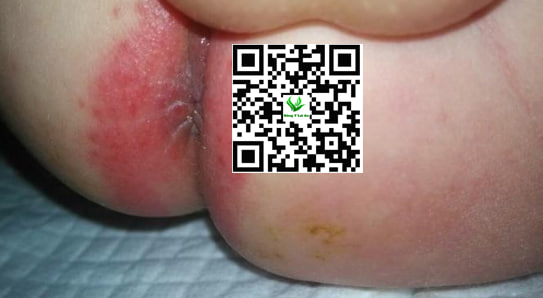 Độ Ẩm Cao, Tiêu Chảy Liên Tục, da kích ứng là nguyên nhân gây hăm hậu môn