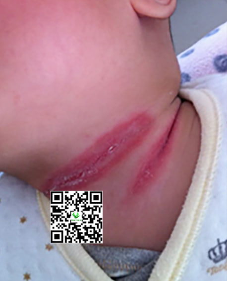 Hăm Cổ Ở Trẻ Sơ Sinh Dễ Tái Phát