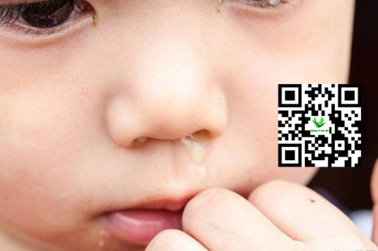 Hắt hơi sổ mũi ở trẻ có thể kèm chảy nước mắt