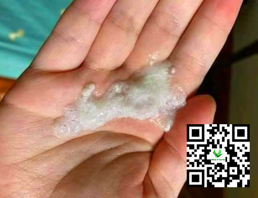 Hình ảnh dịch đờm của bé bị trớ ra