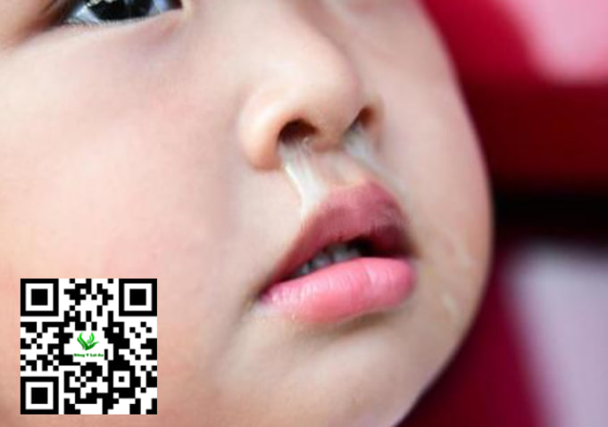 Hút mũi và vệ sinh mũi