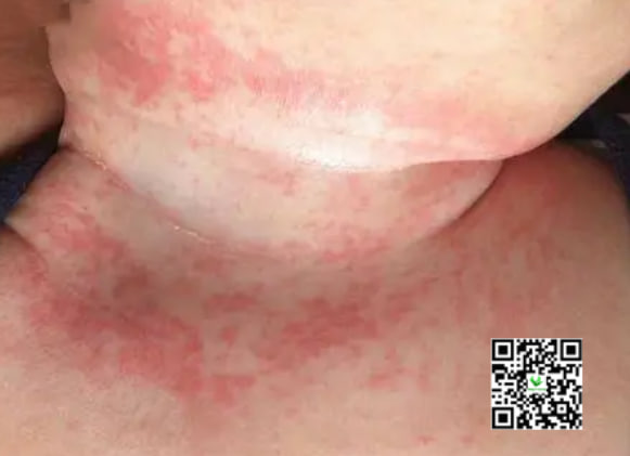 Làm sao để trẻ hết hăm cổ nổi mụn