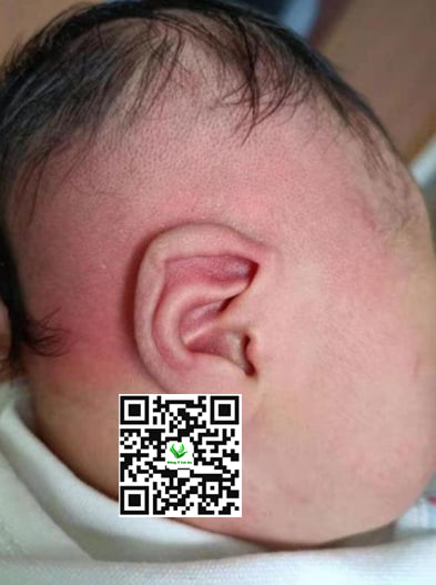 Làn da bé rất dễ đổ mồ hôi dẫn đến dễ hăm kẽ tai