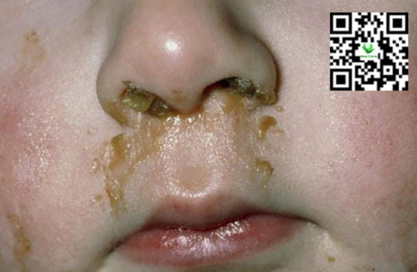 Mức độ nặng của nghẹt mũi