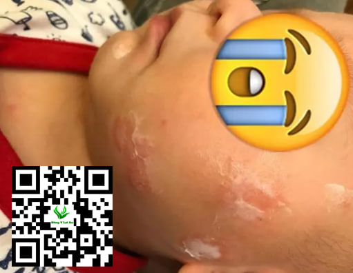 Mức độ trung bình của chàm sữa