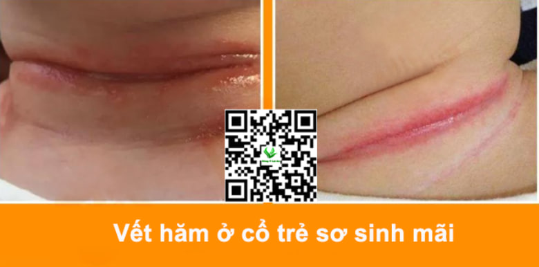 Ngăn Ngừa Tình Trạng Hăm Cổ Tái Phát Ở Bé