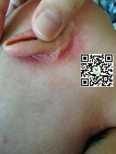 Ngăn ngừa và điều trị hăm tai ở trẻ