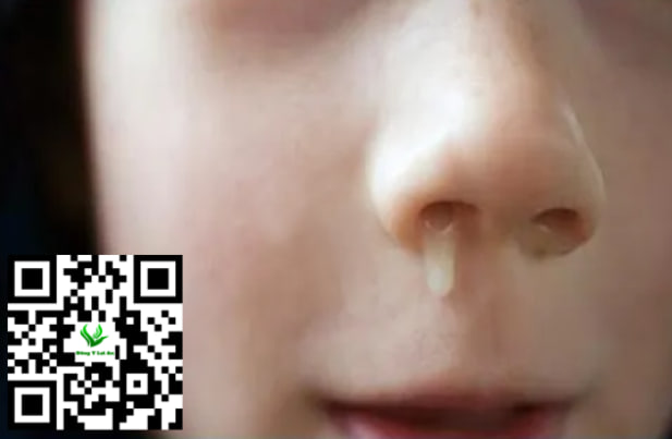 Nguyên Nhân Trẻ Bị Sổ Mũi, Nghẹt Mũi