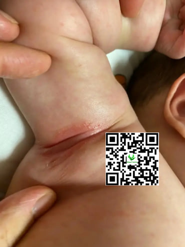 Nguyên nhân gây hăm nách ở trẻ sơ sinh