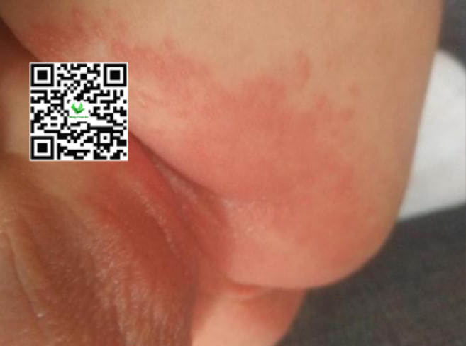 Sử dụng kem chống hăm thảo dược an toàn cho bé bị hăm bìu