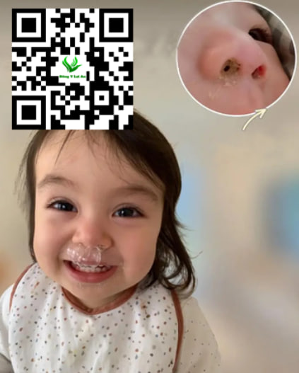 Trẻ Bị Sổ Mũi, Nghẹt Mũi