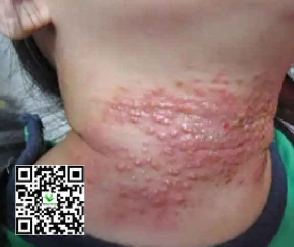Trẻ bị hăm cổ nổi mụn