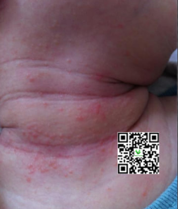 Trẻ sơ sinh bị hăm cổ nổi mụn tắm lá gì