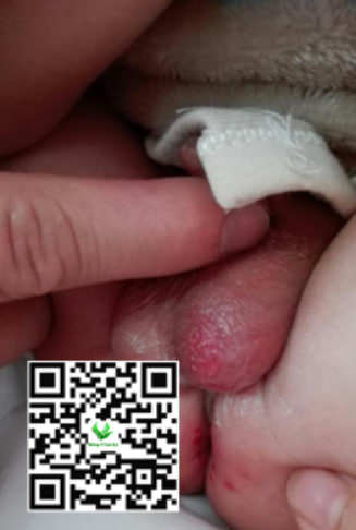 Vệ sinh vùng kín không đúng cách dẫn tới hăm bìu