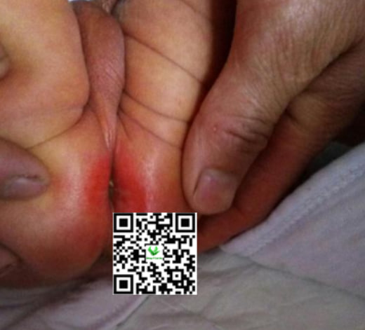 Vùng da hăm bị nứt nẻ, có mủ hoặc có dấu hiệu nhiễm trùng