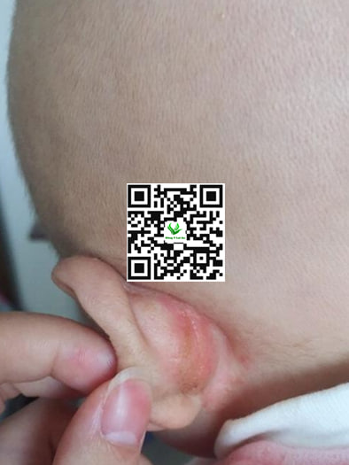 Vùng kẽ tai của bé bị hăm nứt