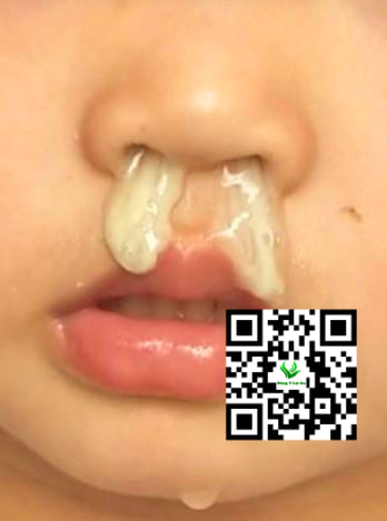 Sổ mũi màu xanh đặc kéo dài ở trẻ