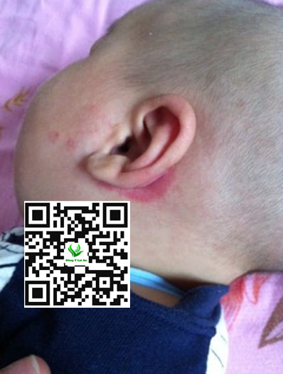 vùng da ở tai bé bị ẩm ướt hoặc cọ xát liên tục